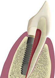 Implantologie Implantologie