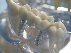 Implantologie Implantologie