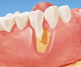 Zahnerhalt Zahnerhalt